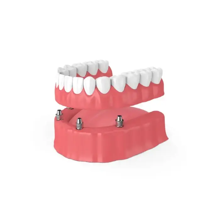 snap-in implant dentures Portland, OR