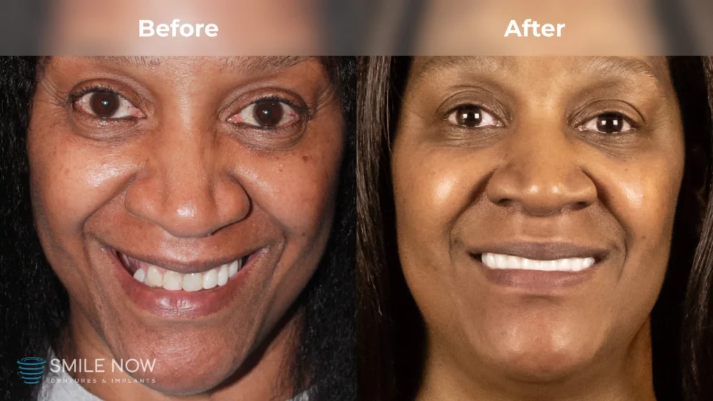 Before and after dental implants in Portland, OR at Smile Now Portland Dentures and Implants
